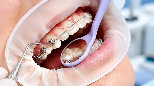 Braces Treatment in Indirapuram: A Step Towards a Healthier Smile