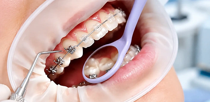 Braces Treatment in Indirapuram: A Step Towards a Healthier Smile