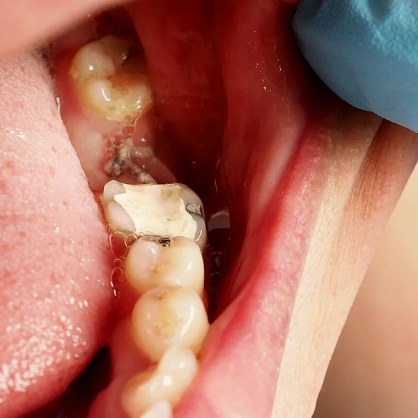 Bone Grafting Services in Indirapuram