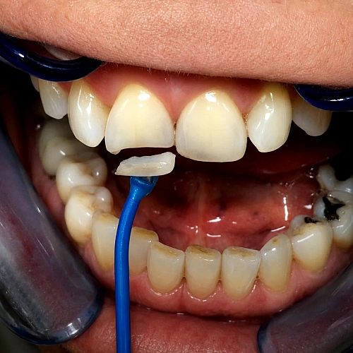 Broken Tooth Repair Manufacturers in Indirapuram