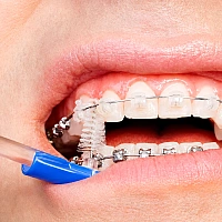 Ceramic Braces