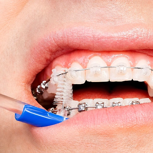 Ceramic Braces Manufacturers in Indirapuram