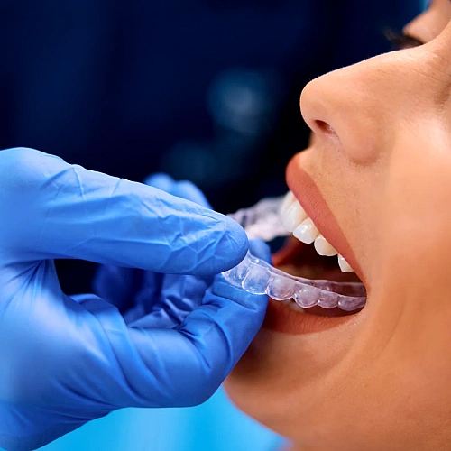 Clear Aligners (Invisalign) Manufacturers in Indirapuram
