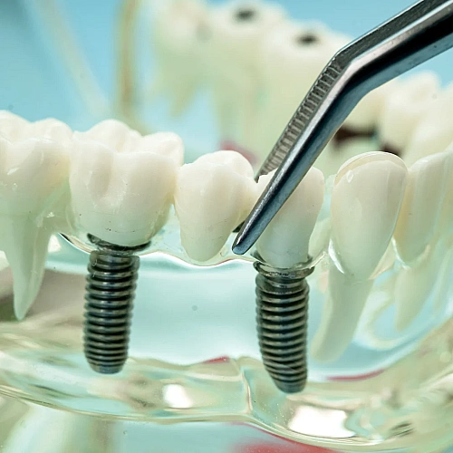 Dental Bridge Manufacturers in Indirapuram