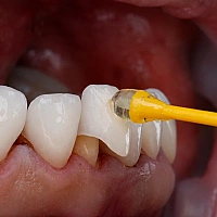 Dental Crown (Cap)