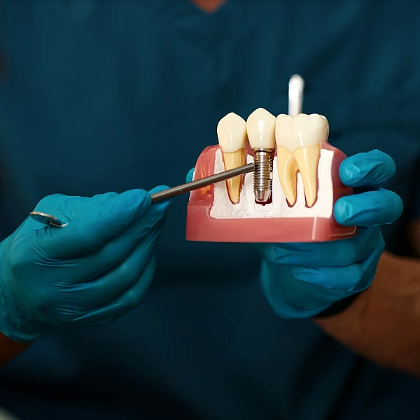 Dental Implants Services in Indirapuram