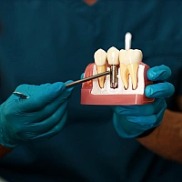 Dental Implants