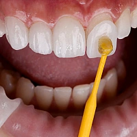 Dental Veneers