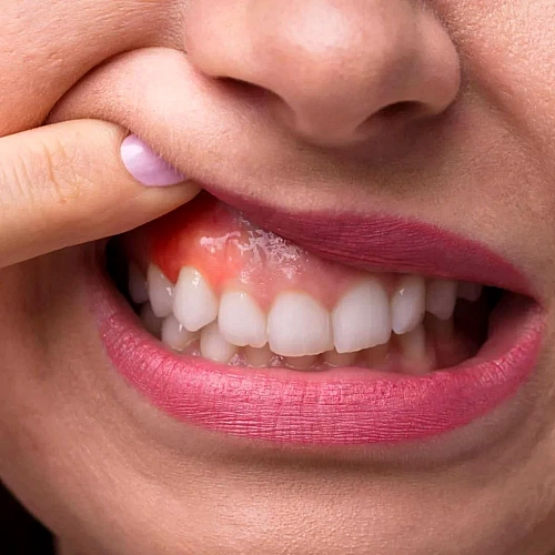 Gum Contouring Manufacturers in Indirapuram
