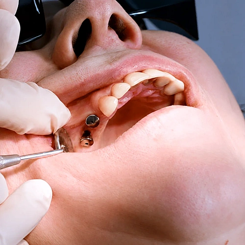 Gum Surgery Manufacturers in Indirapuram