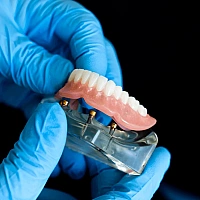 Implant-Supported Dentures