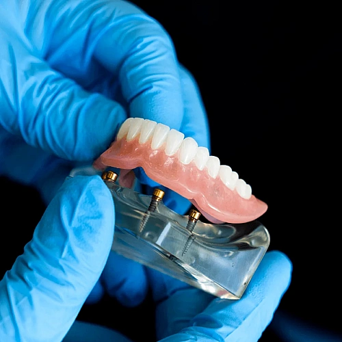 Implant-Supported Dentures Manufacturers in Indirapuram