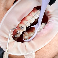Metal Braces