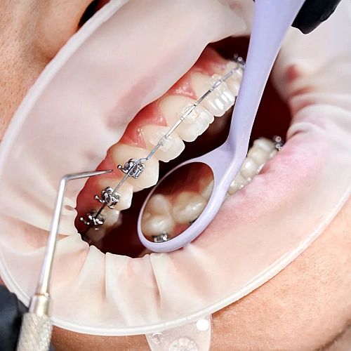 Metal Braces Manufacturers in Indirapuram