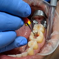 Root Canal Treatment (RCT)