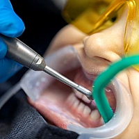 Teeth Cleaning & Scaling
