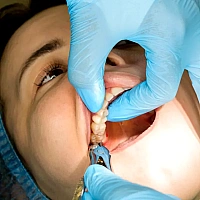 Tooth Extraction