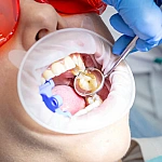 Tooth Filling (Cavity) Manufacturers in Indirapuram