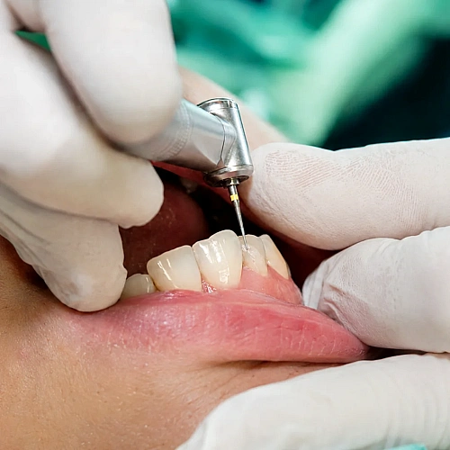 Tooth Reshaping Manufacturers in Indirapuram