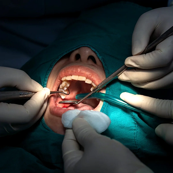 Wisdom Tooth Removal Services in Indirapuram