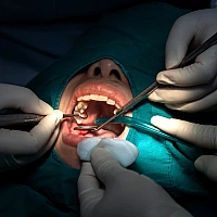 Wisdom Tooth Removal